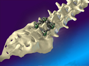 Spinal Fixation System